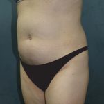 Tummy Tuck Before & After Patient #2885