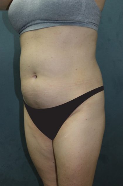 Tummy Tuck Before & After Patient #2885