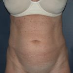 Tummy Tuck Before & After Patient #2832