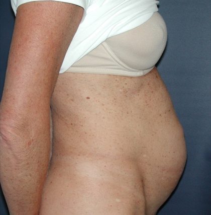 Tummy Tuck Before & After Patient #2832