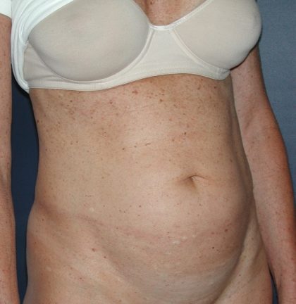 Tummy Tuck Before & After Patient #2832