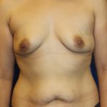 Breast Augmentation Before & After Patient #2892