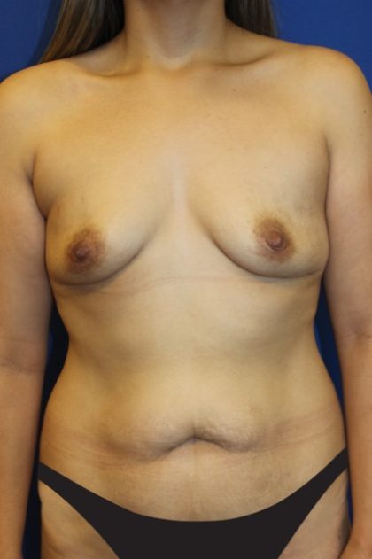 Breast Augmentation Before & After Patient #2892