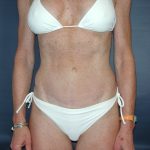 Tummy Tuck Before & After Patient #2832