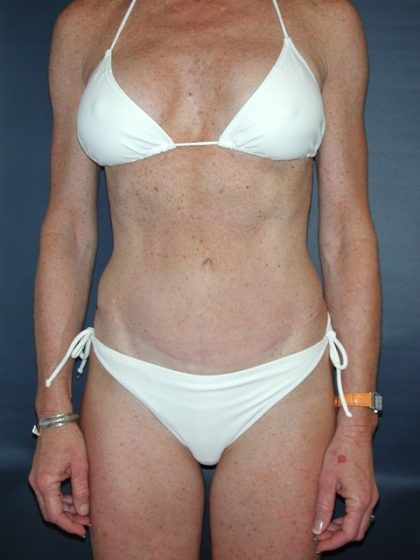 Tummy Tuck Before & After Patient #2832