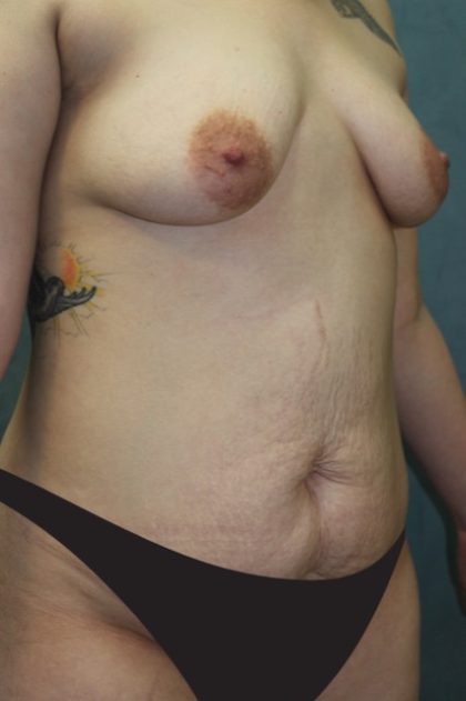 Tummy Tuck Before & After Patient #2970