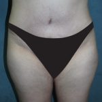 Tummy Tuck Before & After Patient #2970