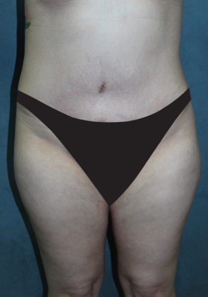 Tummy Tuck Before & After Patient #2970