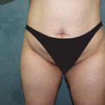 Tummy Tuck Before & After Patient #2970