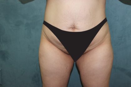 Tummy Tuck Before & After Patient #2970