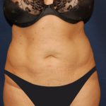 Tummy Tuck Before & After Patient #2853