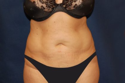 Tummy Tuck Before & After Patient #2853