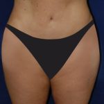 Tummy Tuck Before & After Patient #2853