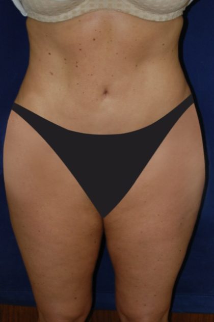 Tummy Tuck Before & After Patient #2853