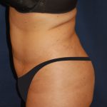 Tummy Tuck Before & After Patient #2853