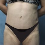 Tummy Tuck Before & After Patient #2869