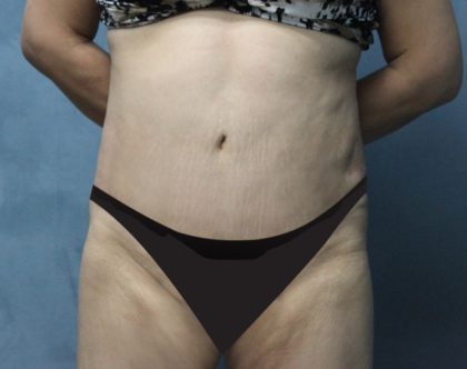 Tummy Tuck Before & After Patient #2869