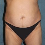 Tummy Tuck Before & After Patient #2869