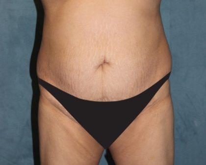 Tummy Tuck Before & After Patient #2869