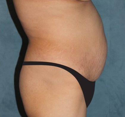 Tummy Tuck Before & After Patient #2869