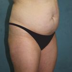 Tummy Tuck Before & After Patient #2869