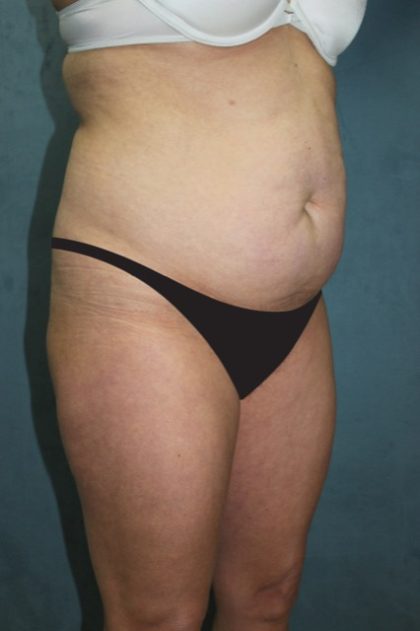 Tummy Tuck Before & After Patient #2869