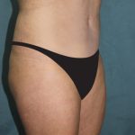 Tummy Tuck Before & After Patient #2869