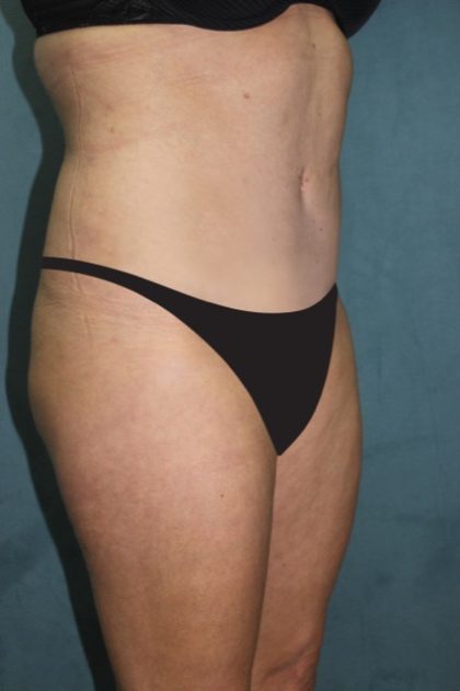 Tummy Tuck Before & After Patient #2869