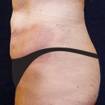 Tummy Tuck Before & After Patient #2858