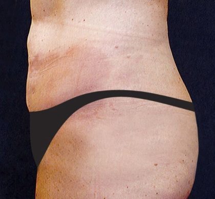 Tummy Tuck Before & After Patient #2858