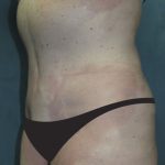 Tummy Tuck Before & After Patient #2858