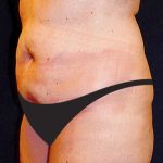 Tummy Tuck Before & After Patient #2858