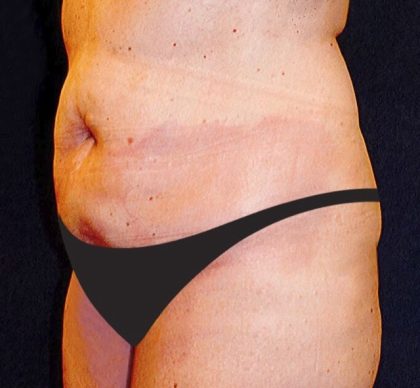 Tummy Tuck Before & After Patient #2858