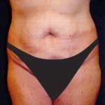 Tummy Tuck Before & After Patient #2858