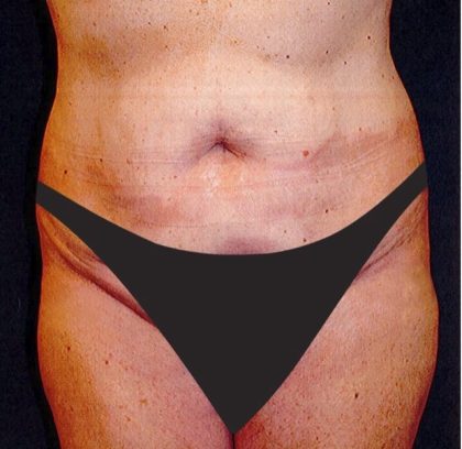 Tummy Tuck Before & After Patient #2858