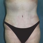 Tummy Tuck Before & After Patient #2858