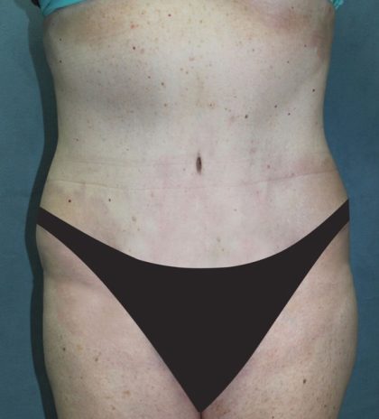 Tummy Tuck Before & After Patient #2858