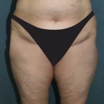 Tummy Tuck Before & After Patient #2880