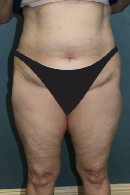 Tummy Tuck Before & After Patient #2880