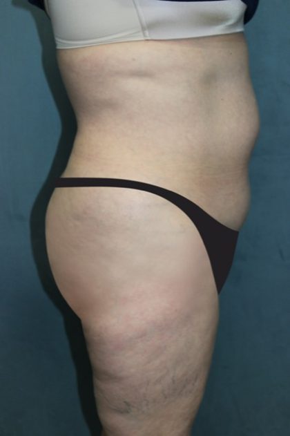 Tummy Tuck Before & After Patient #2880