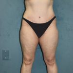 Tummy Tuck Before & After Patient #2880