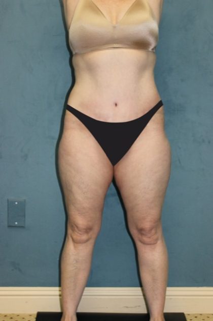 Tummy Tuck Before & After Patient #2880