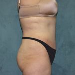 Tummy Tuck Before & After Patient #2880