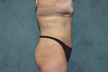 Tummy Tuck Before & After Patient #2880