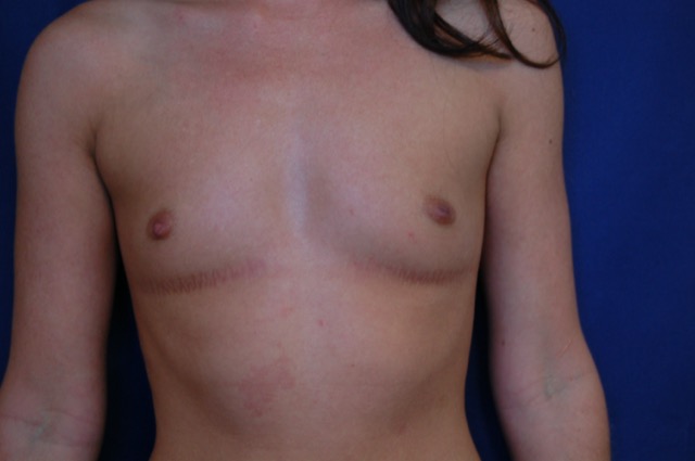 Breast Augmentation Before & After Patient #3492