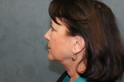 Blepharoplasty Before & After Patient #3302
