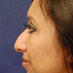 Rhinoplasty Before & After Patient #3389