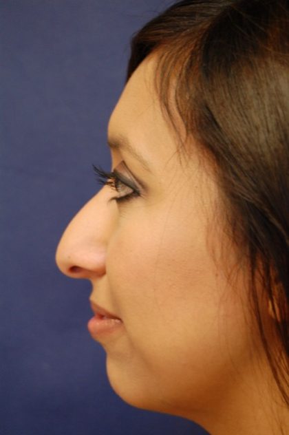 Rhinoplasty Before & After Patient #3389