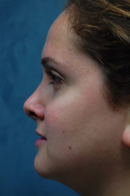 Rhinoplasty Before & After Patient #3384