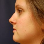 Rhinoplasty Before & After Patient #3384